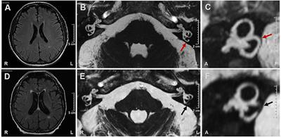 Case Report: Filling Defect in Posterior Semicircular Canal on MRI With Balanced Steady-State Gradient-Echo Sequences After Labyrinthine Ischemia in the Common Cochlear Artery Territory as an Early Sign of Fibrosis